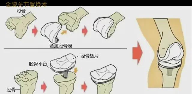 九游娱乐网站：集采再次开标！人工关节阵痛何时休？(图2)